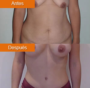 Abdominoplastia 