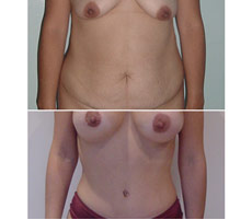 Abdominoplastia