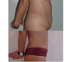 Abdominoplastia