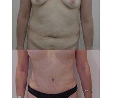 Abdominoplastia