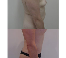 Abdominoplastia