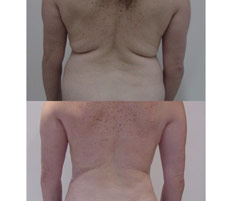 Abdominoplastia