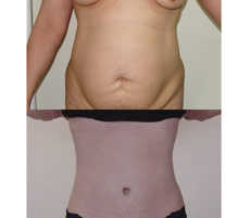 Abdominoplastia