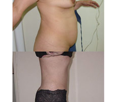 Abdominoplastia