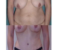 Abdominoplastia