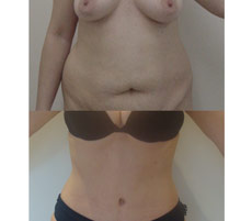 Abdominoplastia