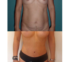 Abdominoplastia