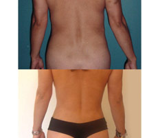 Abdominoplastia