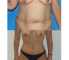 Abdominoplastia