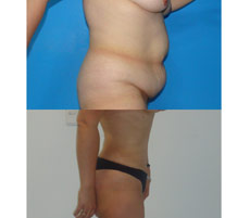 Abdominoplastia