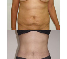 Abdominoplastia