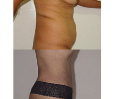 Abdominoplastia