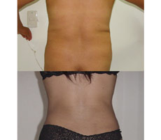 Abdominoplastia