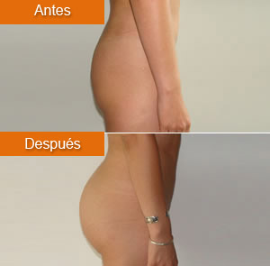 Gluteoplastia 