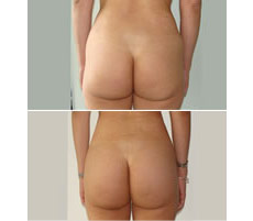 Gluteoplastia