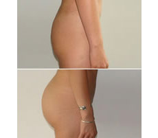 Gluteoplastia