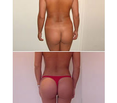 Gluteoplastia