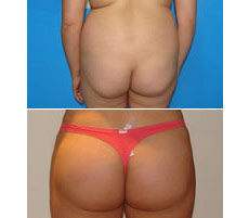 Gluteoplastia