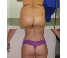 Gluteoplastia