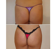 Gluteoplastia