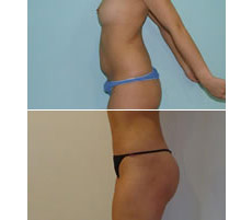 Gluteoplastia
