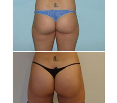 Gluteoplastia