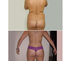 Lipoescultura