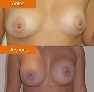 Mamoplastia de Aumento