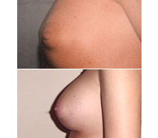 Mamoplastia de Aumento