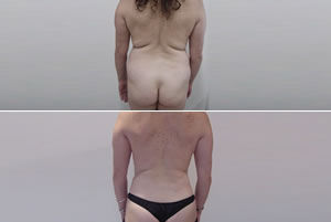 Lipolipectomía