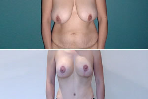 Lipolipectomía