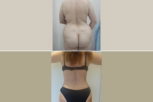 Lipolipectomía