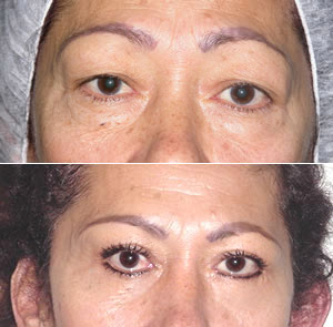 Blefaroplastia