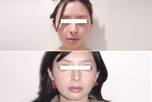 Perfiloplastia