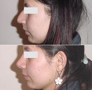 Rinoplastia