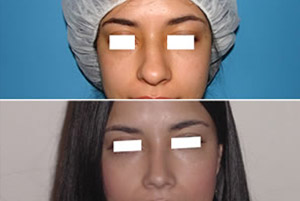 Rinoplastia