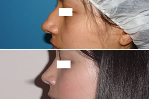 Rinoplastia