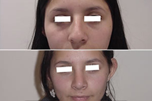 Rinoplastia