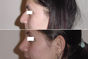 Rinoplastia