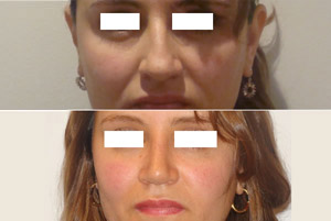 Rinoplastia