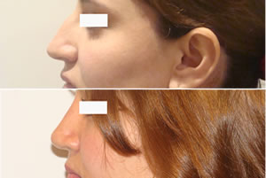 Rinoplastia