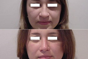 Rinoplastia