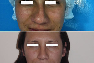 Rinoplastia