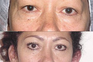 Blefaroplastia