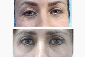 Blefaroplastia