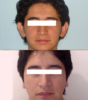 Perfiloplastia 