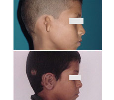 Reconstrucción Auricular
